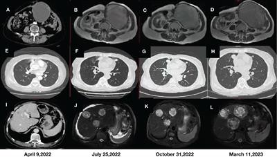 Case Report: Clinical application of immunotherapy-based combination regimen in primary osteosarcoma of the uterus